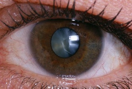 В Красноярске разрабатывают новые методы лечения катаракты