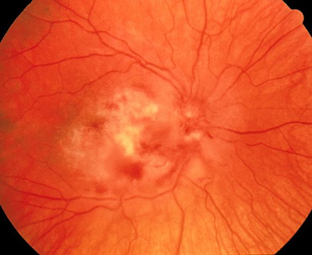 Болезнь Коатса (ретинит)