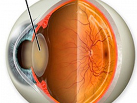 Лечение катаракты глаза без операции - все методы! - катаракта, операция, без операции, методы, лечение