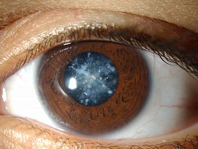 Что такое катаракта - катаракта, помутнение хрусталика
