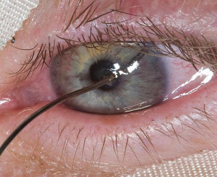 Травмы глаз и способы их лечения